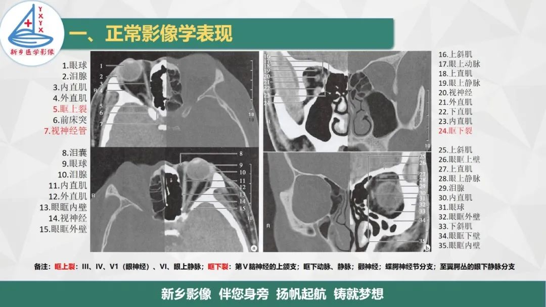 影像PPT - 【PPT】医学影像诊断学教材解读—眼部疾病2-4