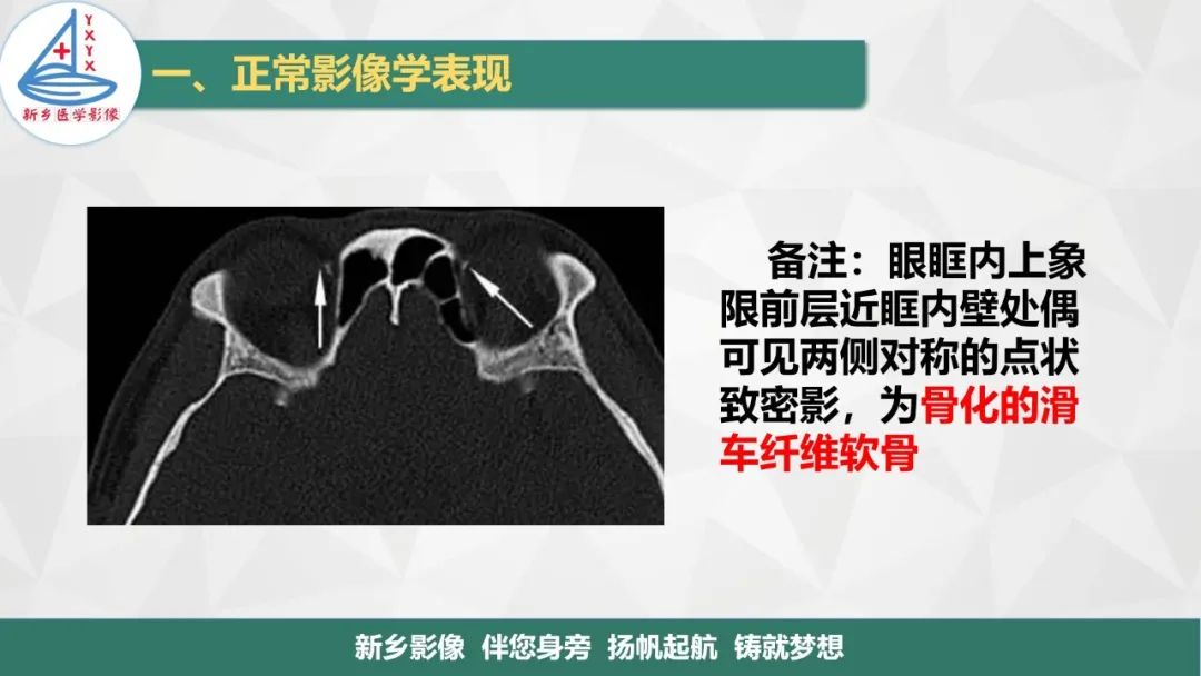 影像PPT - 【PPT】医学影像诊断学教材解读—眼部疾病2-5