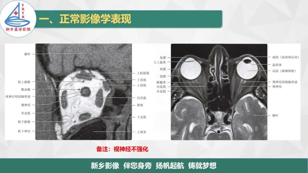 影像PPT - 【PPT】医学影像诊断学教材解读—眼部疾病2-6