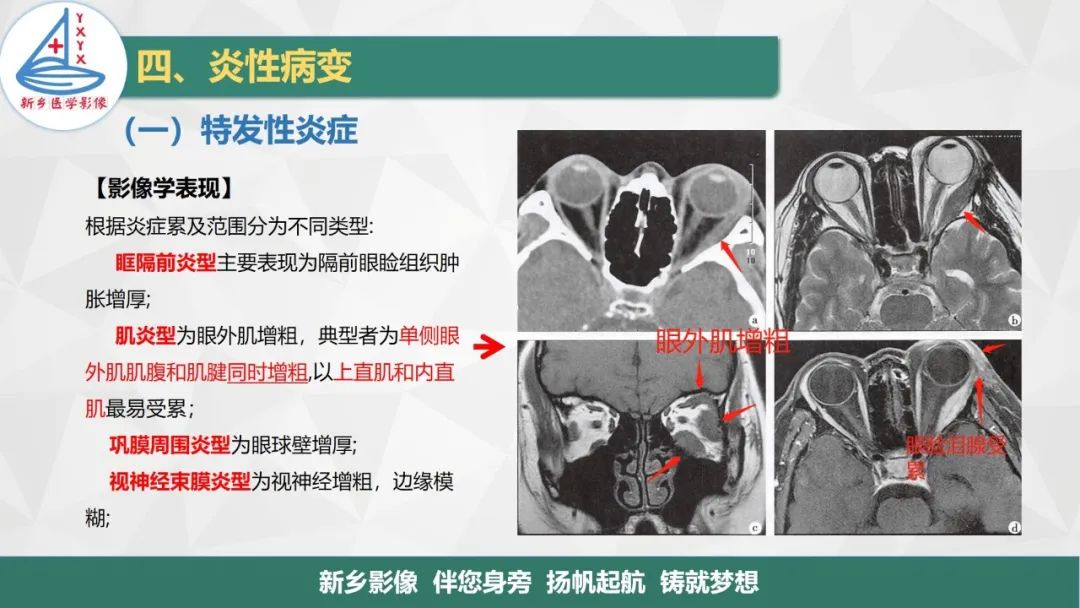 影像PPT - 【PPT】医学影像诊断学教材解读—眼部疾病2-15