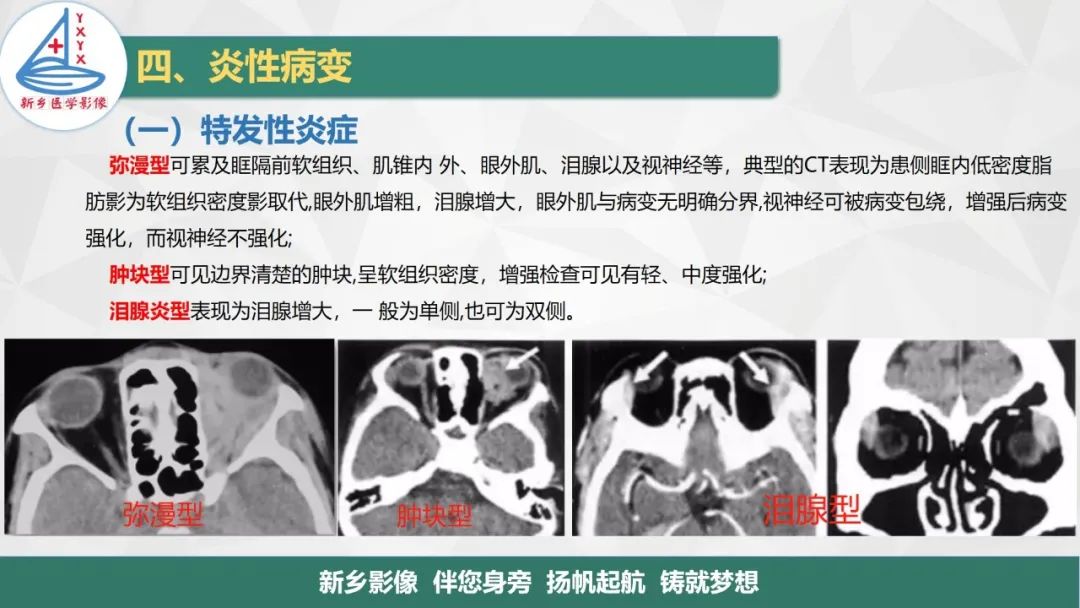 影像PPT - 【PPT】医学影像诊断学教材解读—眼部疾病2-16