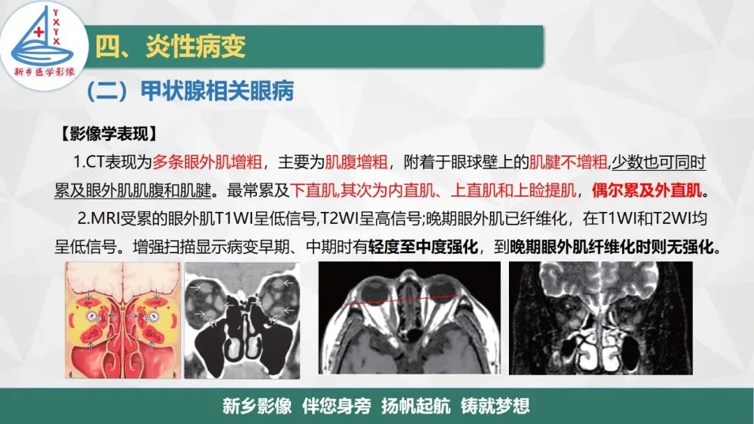 影像PPT - 【PPT】医学影像诊断学教材解读—眼部疾病2-19