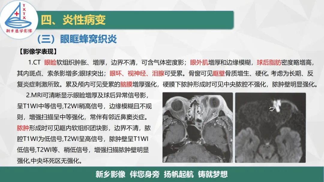 影像PPT - 【PPT】医学影像诊断学教材解读—眼部疾病2-22