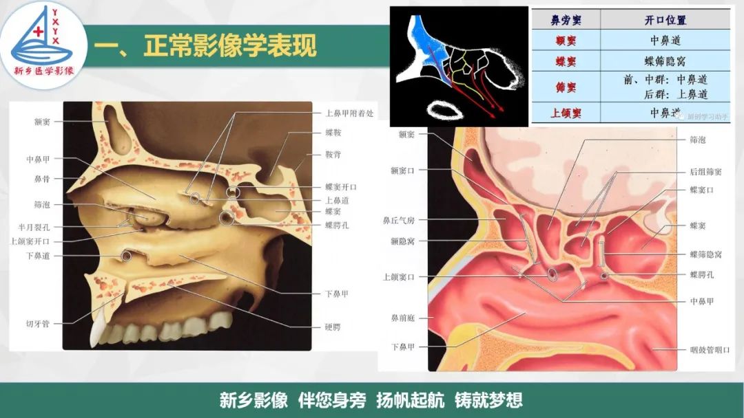 影像PPT - 【PPT】医学影像诊断学教材解读—鼻部疾病-3