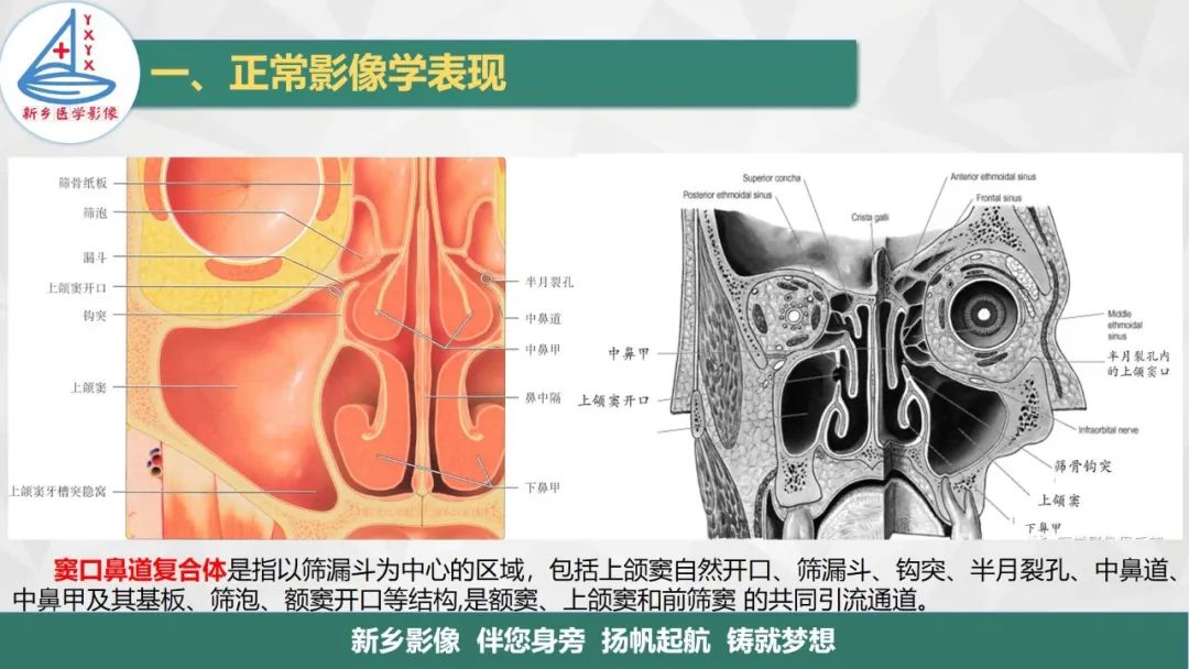 影像PPT - 【PPT】医学影像诊断学教材解读—鼻部疾病-4