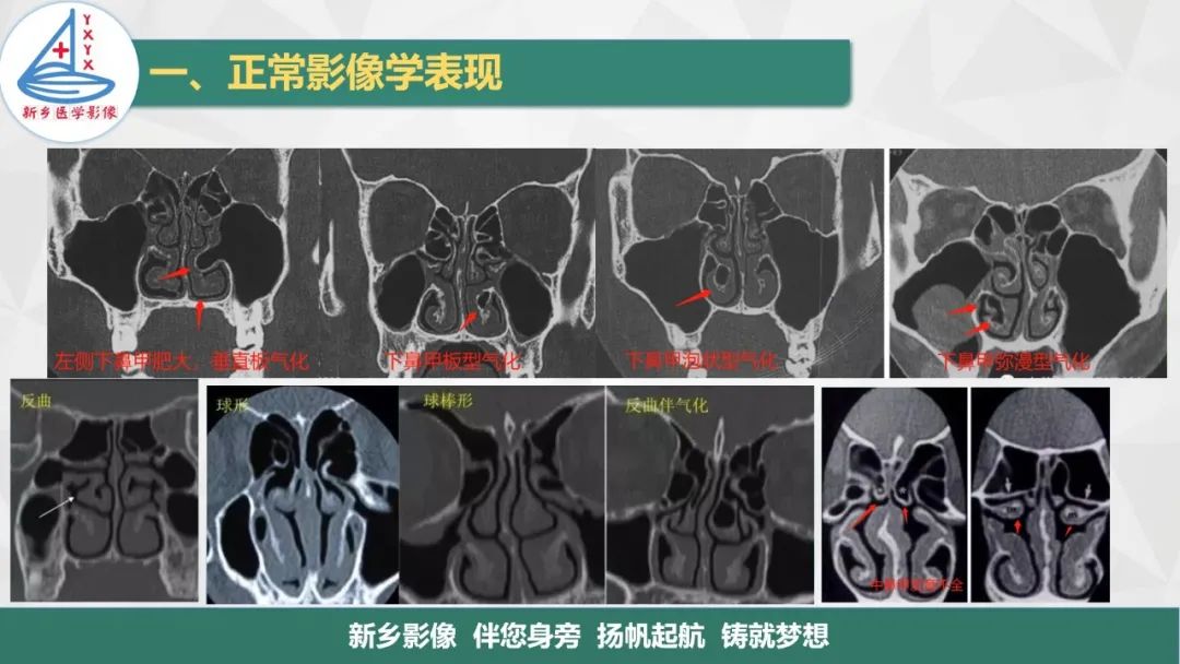 影像PPT - 【PPT】医学影像诊断学教材解读—鼻部疾病-6