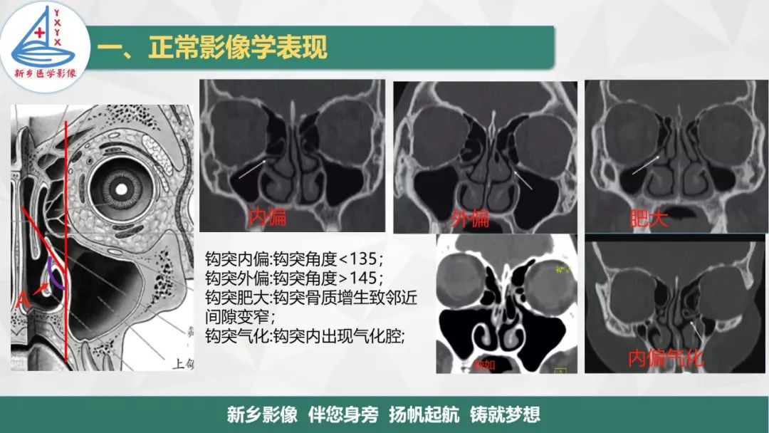 影像PPT - 【PPT】医学影像诊断学教材解读—鼻部疾病-5