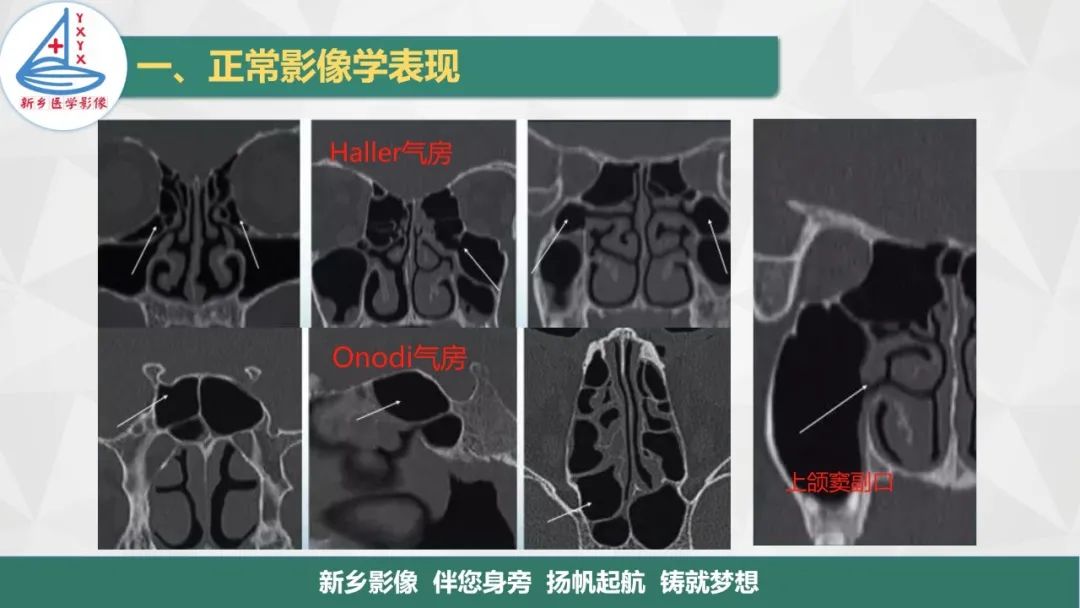影像PPT - 【PPT】医学影像诊断学教材解读—鼻部疾病-8