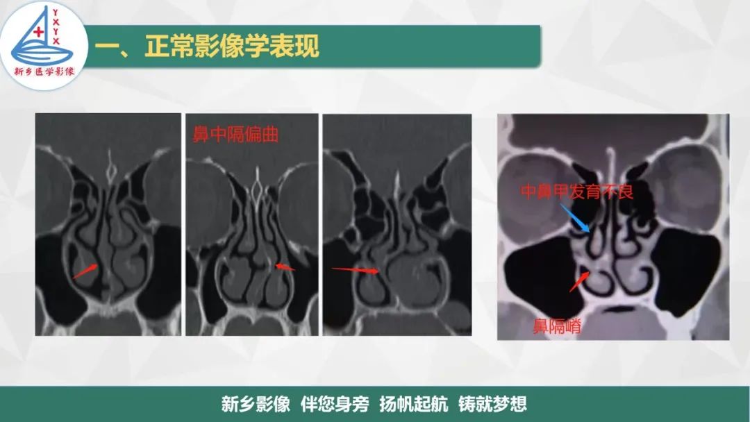 影像PPT - 【PPT】医学影像诊断学教材解读—鼻部疾病-7