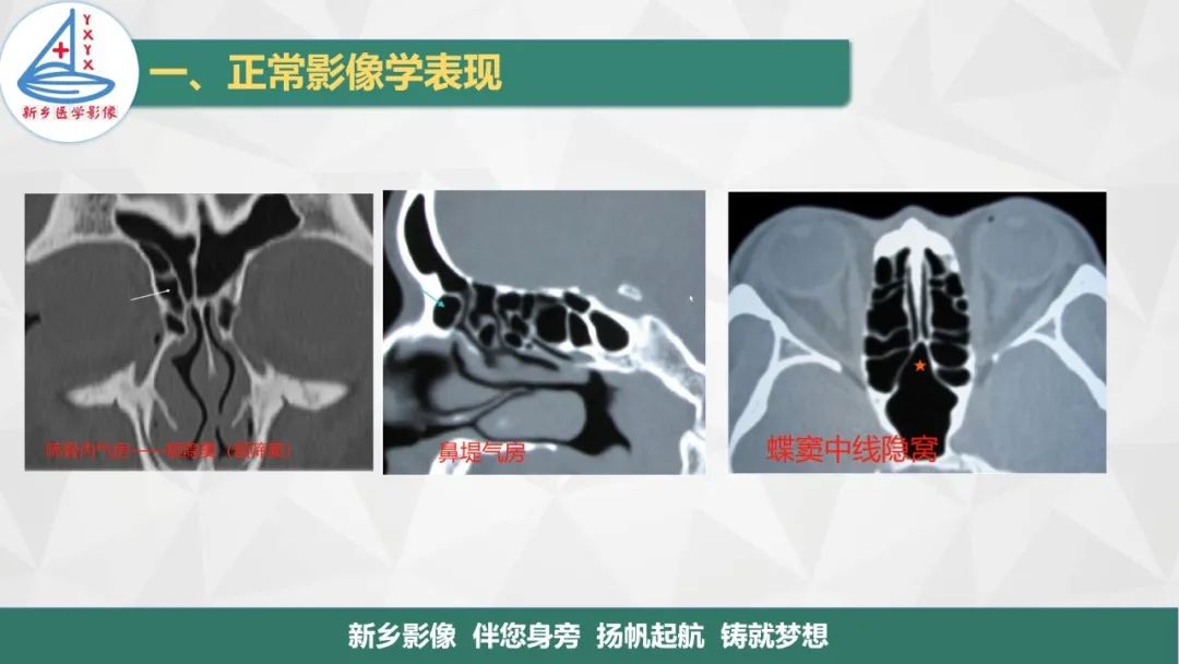 影像PPT - 【PPT】医学影像诊断学教材解读—鼻部疾病-10