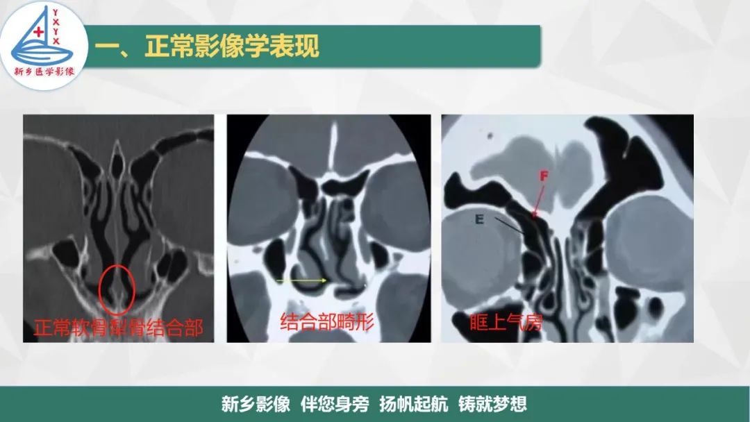 影像PPT - 【PPT】医学影像诊断学教材解读—鼻部疾病-9