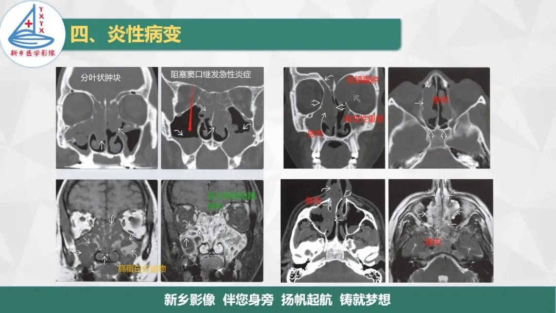 影像PPT - 【PPT】医学影像诊断学教材解读—鼻部疾病-22