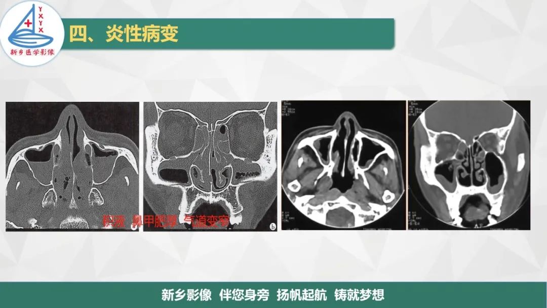 影像PPT - 【PPT】医学影像诊断学教材解读—鼻部疾病-19