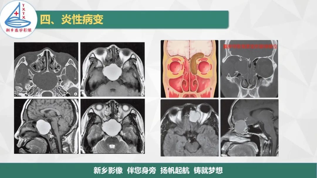 影像PPT - 【PPT】医学影像诊断学教材解读—鼻部疾病-25