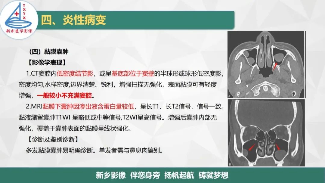 影像PPT - 【PPT】医学影像诊断学教材解读—鼻部疾病-27
