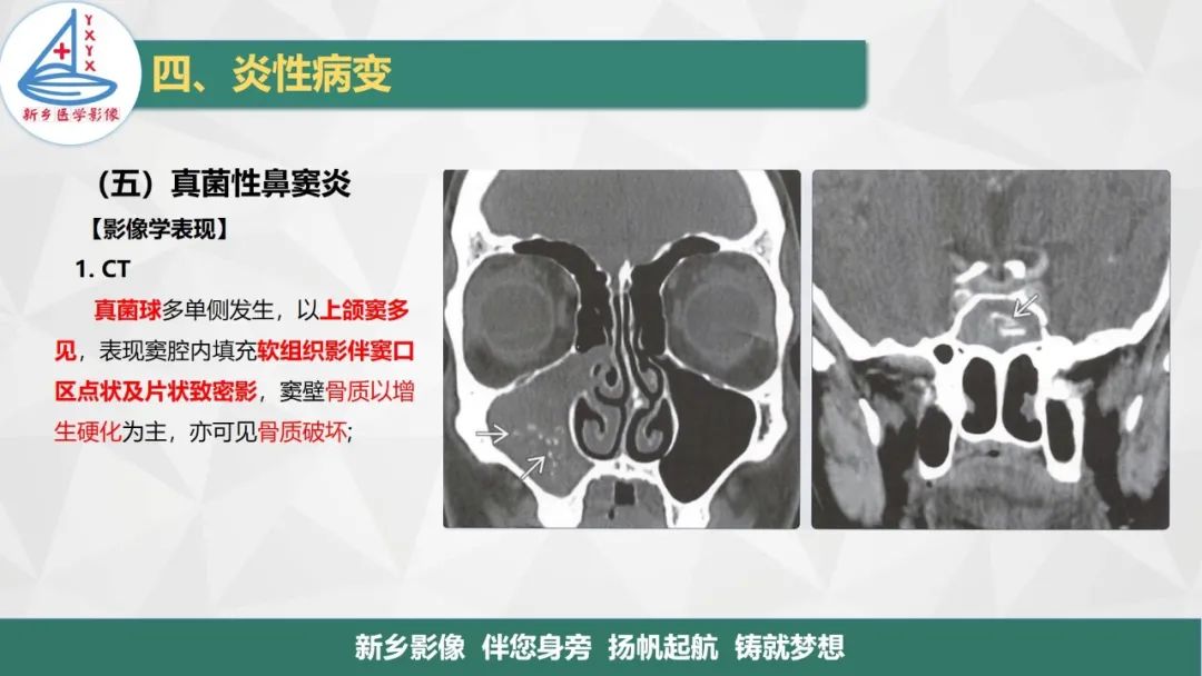 影像PPT - 【PPT】医学影像诊断学教材解读—鼻部疾病-29