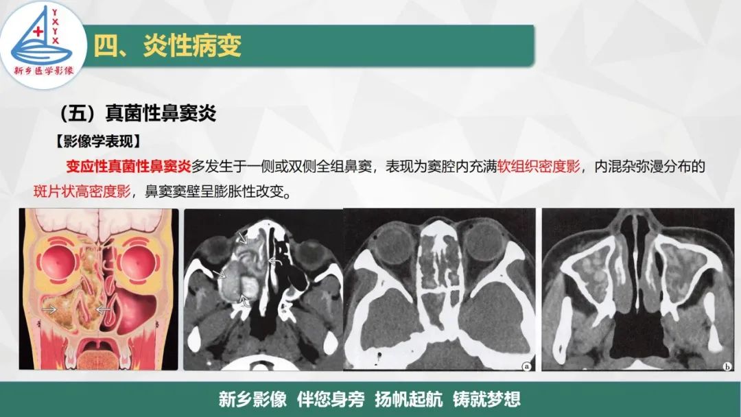 影像PPT - 【PPT】医学影像诊断学教材解读—鼻部疾病-30