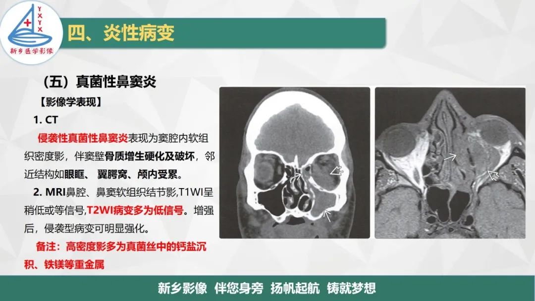 影像PPT - 【PPT】医学影像诊断学教材解读—鼻部疾病-31