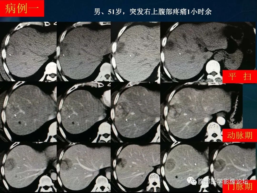 影像PPT - 【PPT】肝脏常见富血供病变读片-2