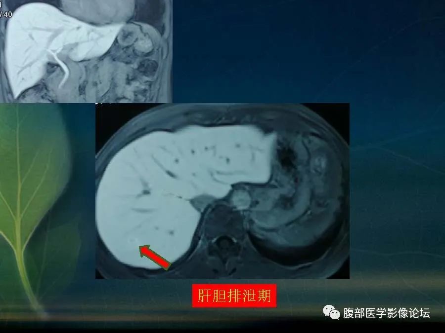 影像PPT - 【PPT】肝脏常见富血供病变读片-6