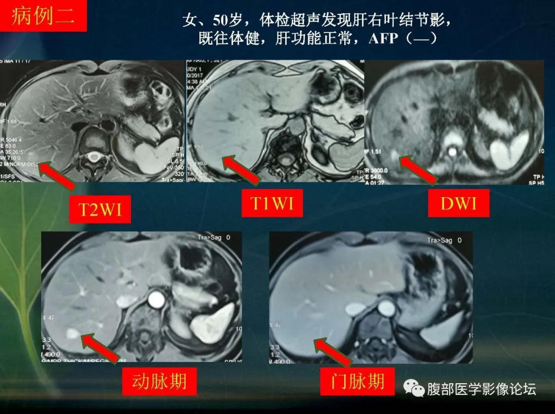 影像PPT - 【PPT】肝脏常见富血供病变读片-5