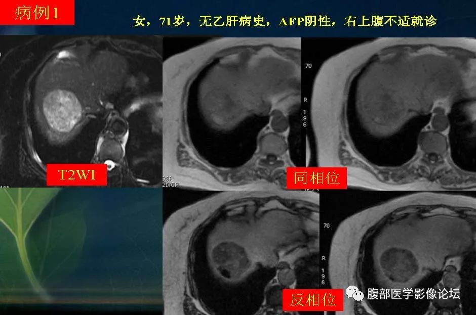 影像PPT - 【PPT】肝脏常见富血供病变读片-21