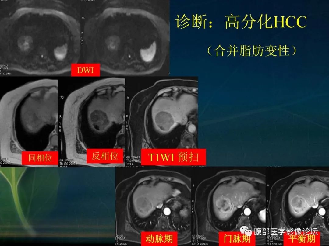 影像PPT - 【PPT】肝脏常见富血供病变读片-22