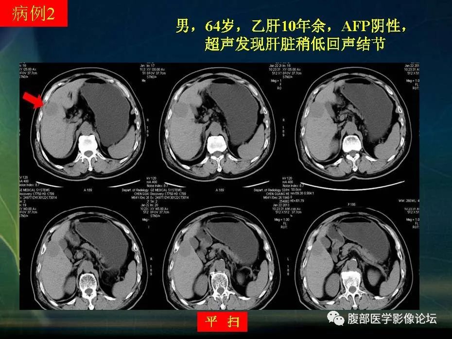 影像PPT - 【PPT】肝脏常见富血供病变读片-23