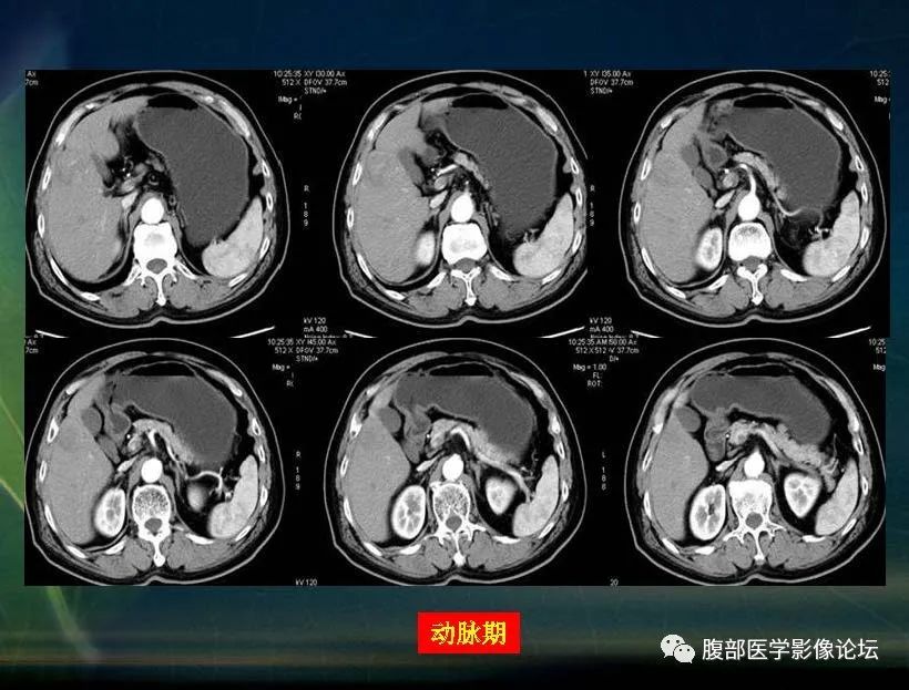 影像PPT - 【PPT】肝脏常见富血供病变读片-24