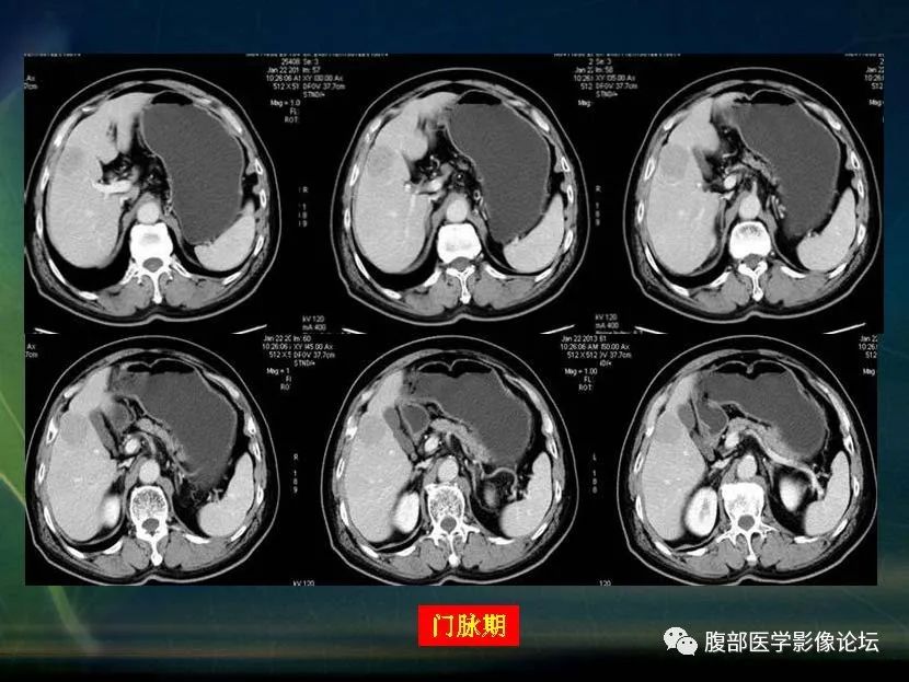 影像PPT - 【PPT】肝脏常见富血供病变读片-25