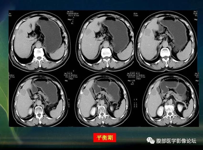 影像PPT - 【PPT】肝脏常见富血供病变读片-26