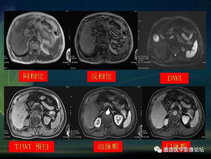 影像PPT - 【PPT】肝脏常见富血供病变读片-28