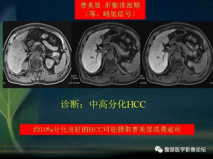 影像PPT - 【PPT】肝脏常见富血供病变读片-29