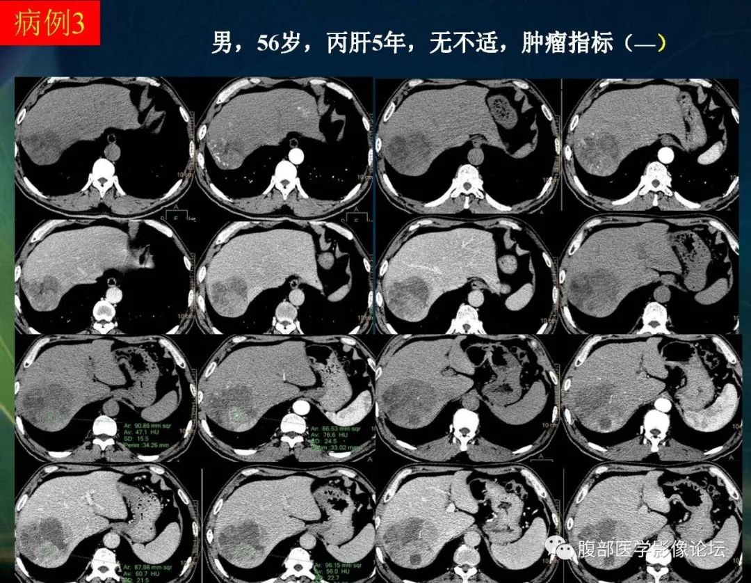 影像PPT - 【PPT】肝脏常见富血供病变读片-30