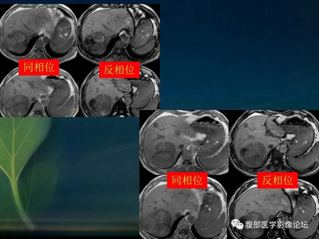 影像PPT - 【PPT】肝脏常见富血供病变读片-32