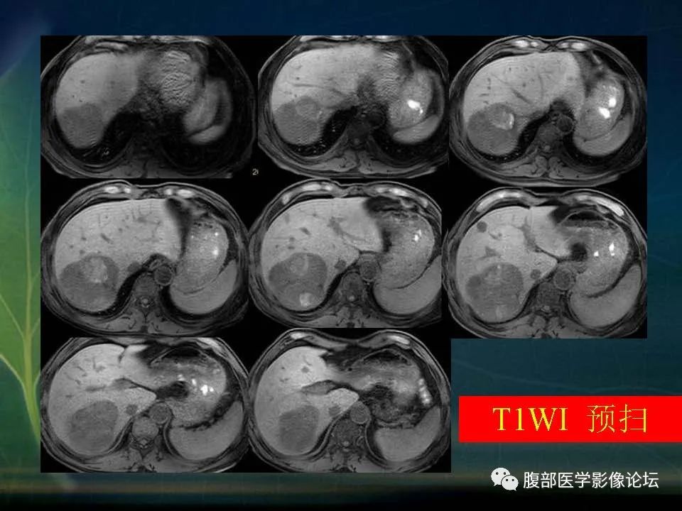 影像PPT - 【PPT】肝脏常见富血供病变读片-34