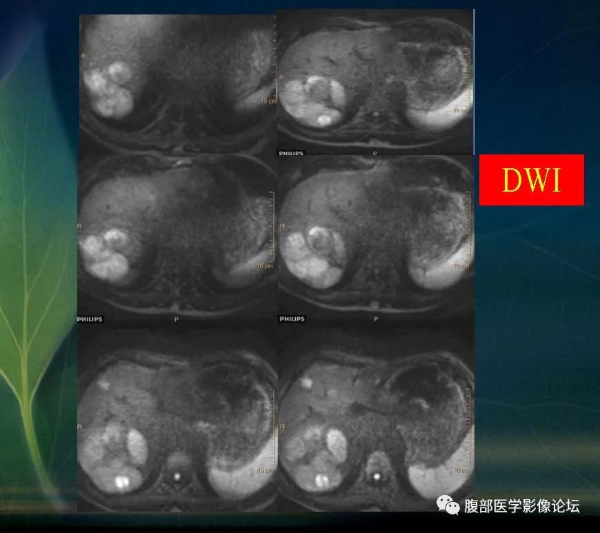 影像PPT - 【PPT】肝脏常见富血供病变读片-33