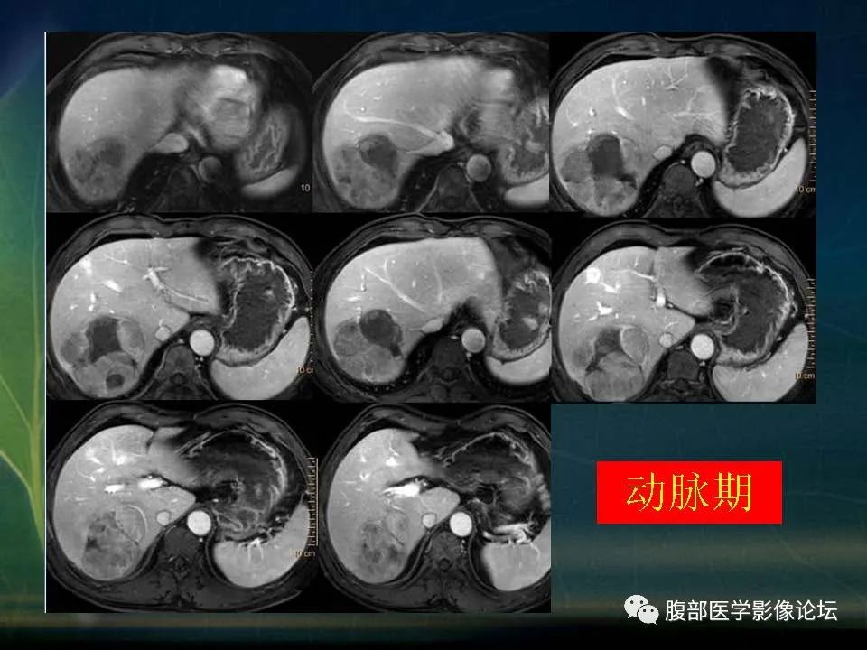 影像PPT - 【PPT】肝脏常见富血供病变读片-35