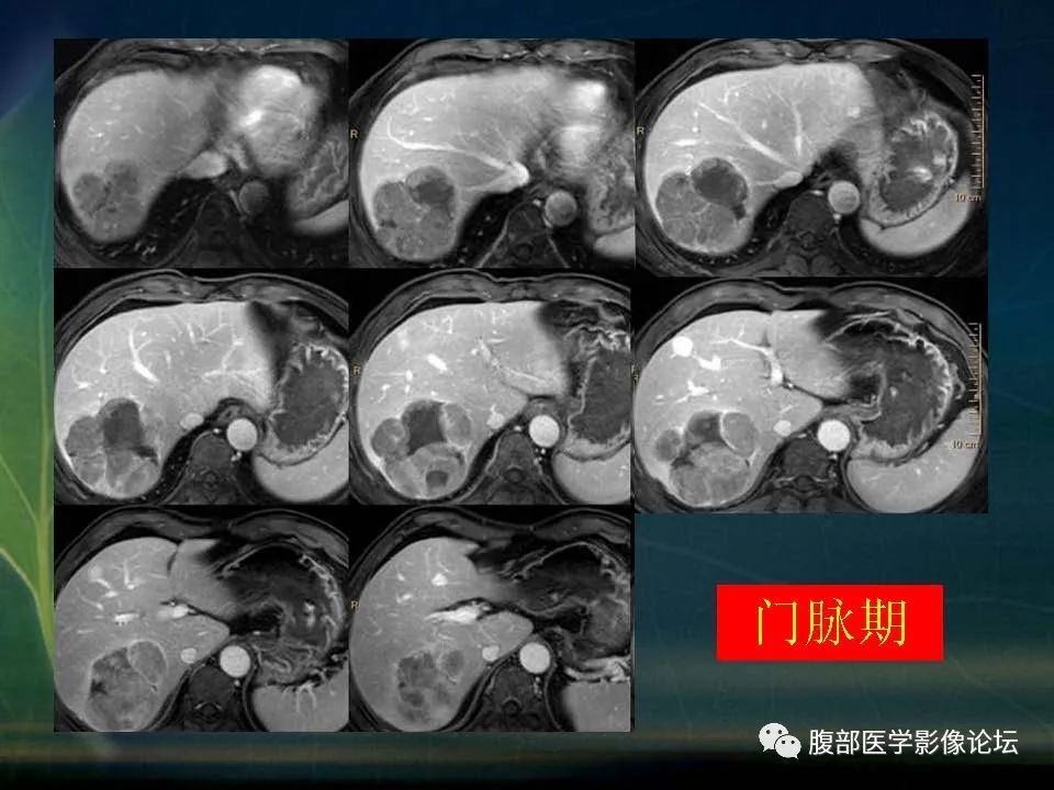 影像PPT - 【PPT】肝脏常见富血供病变读片-36
