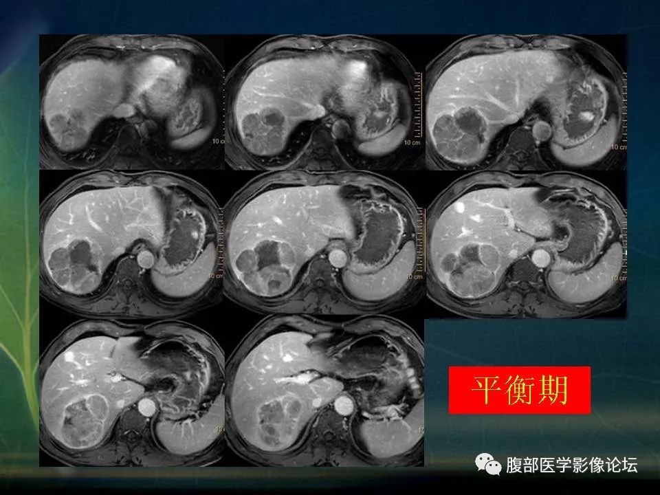 影像PPT - 【PPT】肝脏常见富血供病变读片-37