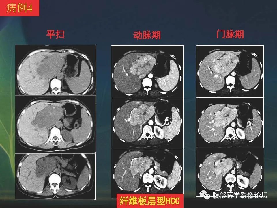 影像PPT - 【PPT】肝脏常见富血供病变读片-42