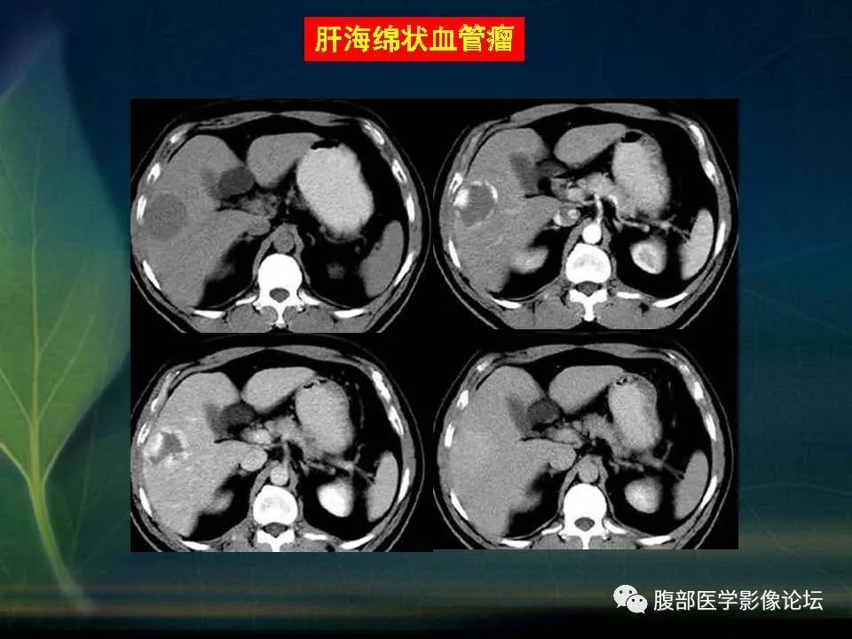影像PPT - 【PPT】肝脏常见富血供病变读片-46