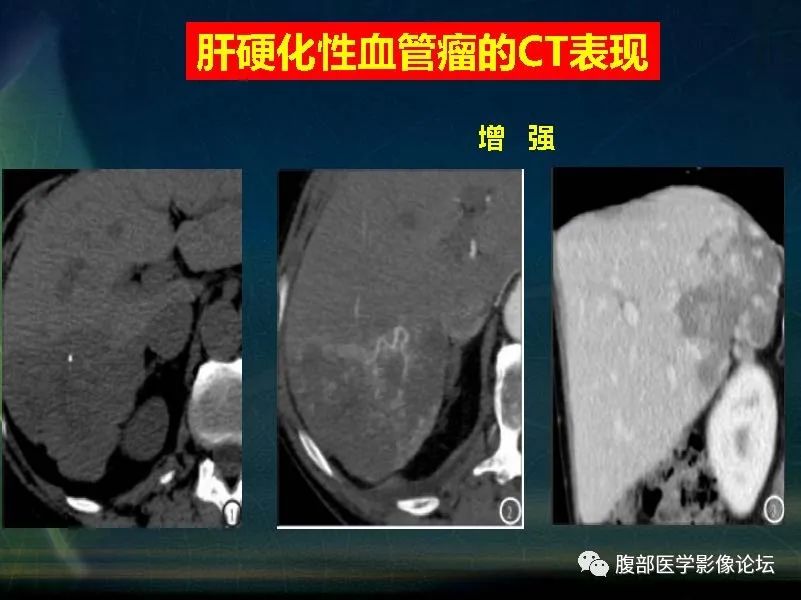 影像PPT - 【PPT】肝脏常见富血供病变读片-48