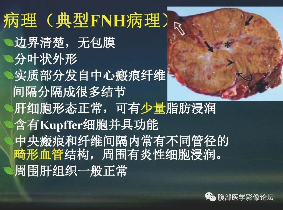 影像PPT - 【PPT】肝脏常见富血供病变读片-52