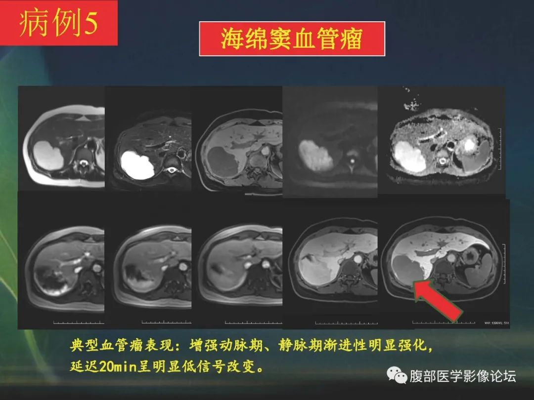 影像PPT - 【PPT】肝脏常见富血供病变读片-47