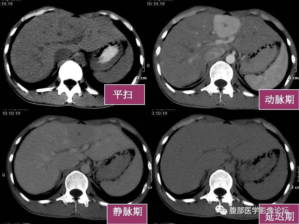 影像PPT - 【PPT】肝脏常见富血供病变读片-53