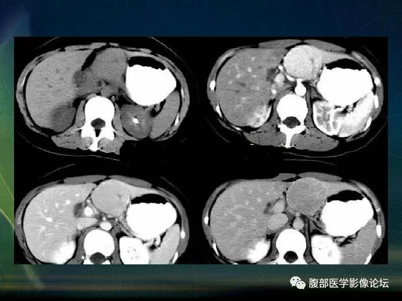 影像PPT - 【PPT】肝脏常见富血供病变读片-55