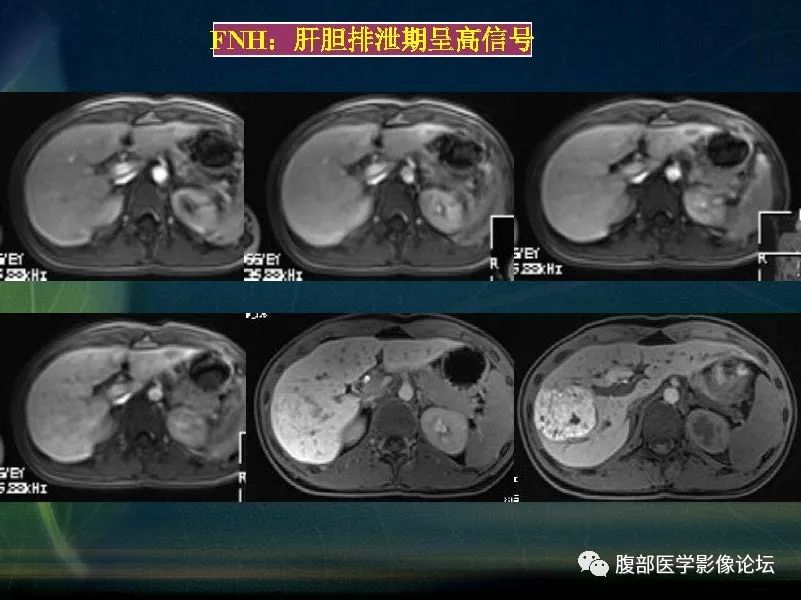 影像PPT - 【PPT】肝脏常见富血供病变读片-59