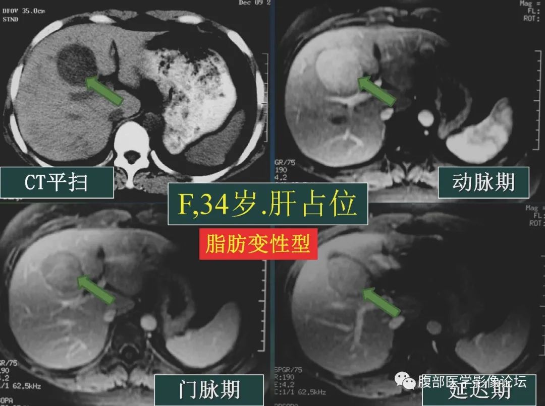 影像PPT - 【PPT】肝脏常见富血供病变读片-63