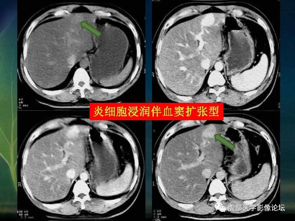 影像PPT - 【PPT】肝脏常见富血供病变读片-62